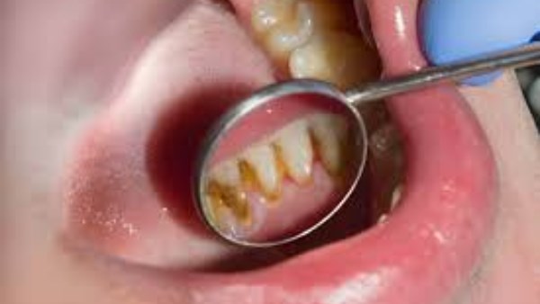 دون الحاجة للذهاب إلى الطبيب .. طرق طبيعية وآمنة للتخلص من جير الأسنان دون الحاجة للذهاب إلى الطبيب .. طرق طبيعية وآمنة للتخلص من جير الأسنان