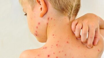 بعد انتشار الحصبة في 25 ولاية أمريكية.. كيف نحمي أطفالنا من العدوى والأمراض؟