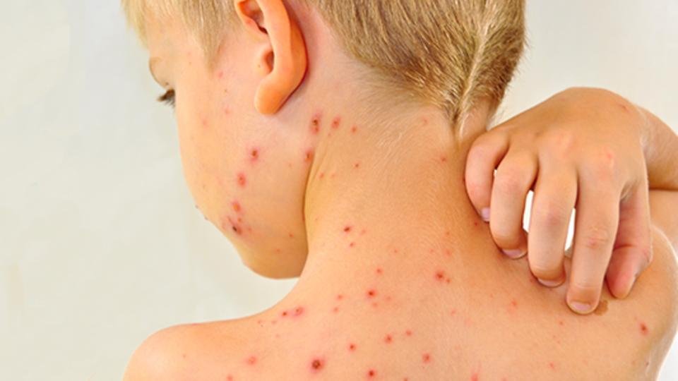 بعد انتشار الحصبة في 25 ولاية أمريكية.. كيف نحمي أطفالنا من العدوى والأمراض؟ بعد انتشار الحصبة في 25 ولاية أمريكية.. كيف نحمي أطفالنا من العدوى والأمراض؟
