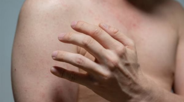 قلق في كندا بسبب انتشار الحصبة.. والسلطات تكثف حملات التطعيم
