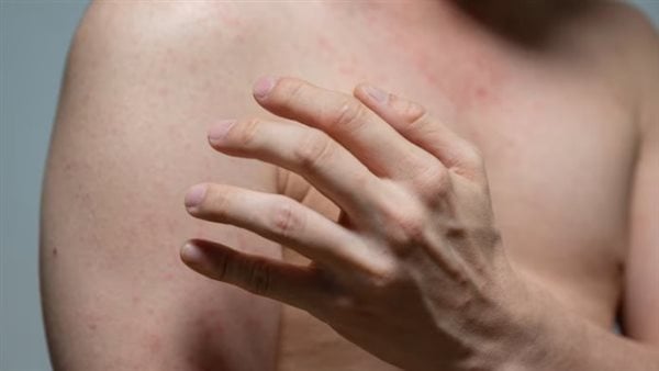 قلق في كندا بسبب انتشار الحصبة.. والسلطات تكثف حملات التطعيم قلق في كندا بسبب انتشار الحصبة.. والسلطات تكثف حملات التطعيم