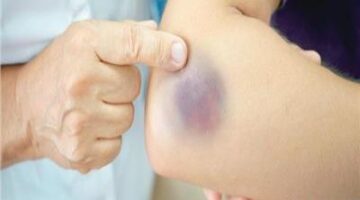 مضاعفات مرض الهيموفيليا النزف المستمر.. الصحة توضح