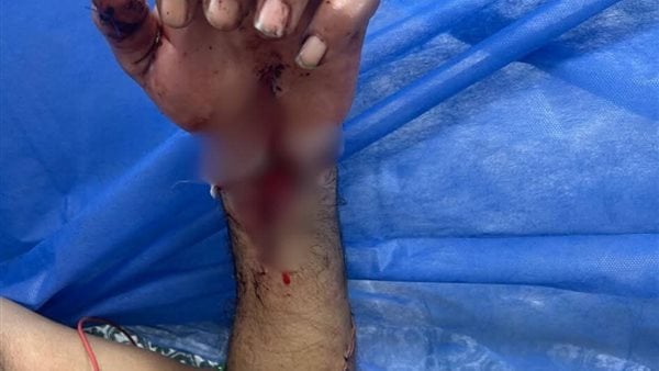 استغرقت 12 ساعة.. نجاح عملية دقيقة لإعادة توصيل يد مبتورة بمجمع السويس الطبي استغرقت 12 ساعة.. نجاح عملية دقيقة لإعادة توصيل يد مبتورة بمجمع السويس الطبي