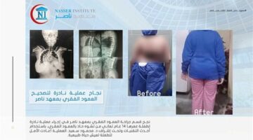 «معهد ناصر» يجري جراحة نادرة في العمود الفقري لطفلة عمرها 14 عامًا