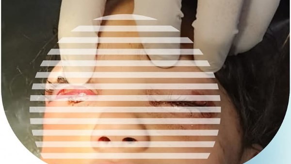 الكحل المؤذي.. فريق طبي ينقذ عيون 3 صغار بكفر الشيخ