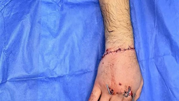 بالصور.. فريق طبي بمستشفي سيد جلال يعيد يد شاب بعد بترها بالصور.. فريق طبي بمستشفي سيد جلال يعيد يد شاب بعد بترها