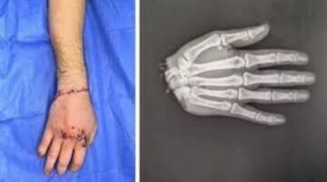بعد نجاح طب الأزهر.. اكتشف شروط إعادة زراعة اليد وكم ساعة تظل حية