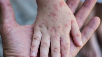 الحصبة تنتشر في مدينة أمريكية جديدة.. وخبراء يحذرون من ارتفاع الإصابات