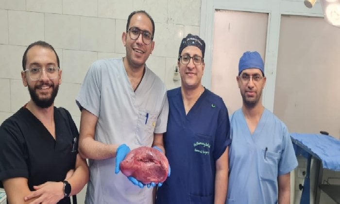 استئصال طحال متضخم يزن 2 كيلو من مريضة بمستشفى أسيوط العام استئصال طحال متضخم يزن 2 كيلو من مريضة بمستشفى أسيوط العام