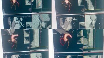 مستشفى منوف العام تسجل إنجازا طبيا بإجراء أول أشعة مقطعية للقلب دون تدخل جراحي