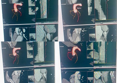 مستشفى منوف العام تسجل إنجازا طبيا بإجراء أول أشعة مقطعية للقلب دون تدخل جراحي مستشفى منوف العام تسجل إنجازا طبيا بإجراء أول أشعة مقطعية للقلب دون تدخل جراحي