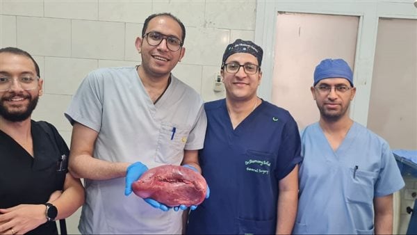 استئصال طحال متضخم يزن 2 كيلو من مريضة بمستشفى أسيوط العام استئصال طحال متضخم يزن 2 كيلو من مريضة بمستشفى أسيوط العام
