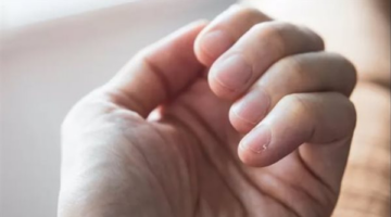 الظفر المتدلي أو “الودنة”.. أسبابه وطرق التخلص من ألمه