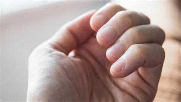 الظفر المتدلي أو “الودنة”.. أسبابه وطرق التخلص من ألمه