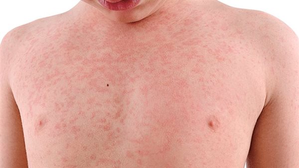 انتشار الحصبة في 25 ولاية أمريكية.. وتسجيل 541 حالة إصابة في تكساس انتشار الحصبة في 25 ولاية أمريكية.. وتسجيل 541 حالة إصابة في تكساس