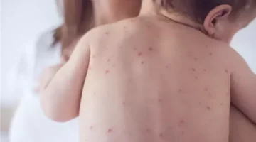 رويترز: الحصبة تنتشر في 25 ولاية أمريكية