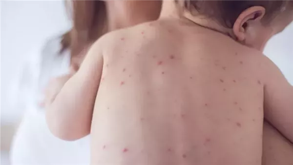 رويترز: الحصبة تنتشر في 25 ولاية أمريكية رويترز: الحصبة تنتشر في 25 ولاية أمريكية