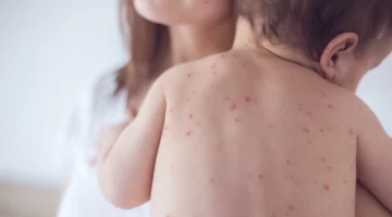 الصحة العالمية تجدد شهادة خلو مصر من الحصبة والحصبة الألمانية للعام الثاني