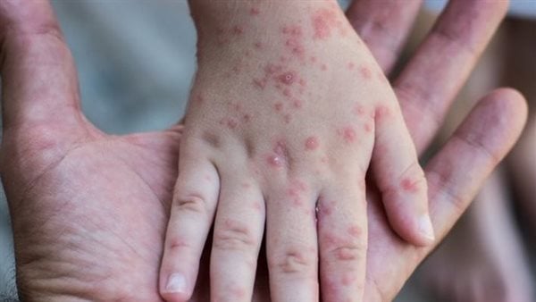 أمريكا تشهد ارتفاعًا قياسيًا في إصابات الحصبة.. والخبراء يحذرون من تفشيه