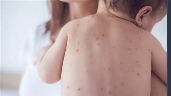 الحصبة تجتاح خُمس الولايات الأمريكية والحالات تناهز الـ 900 الحصبة تجتاح خُمس الولايات الأمريكية والحالات تناهز الـ 900