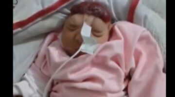 صدمة في غزة.. ولادة طفلة “بلا دماغ” ومطالب بالتحقيق في الأسلحة التي تستخدمها إسرائيل بحرب الإبادة.. (صورة/فيديو)