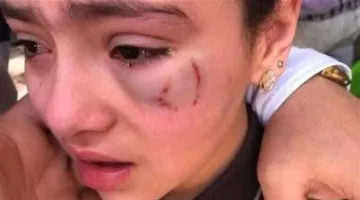 تصالح بين أسرة الطفلة “حنين” والمعلم بعد إصابتها في عينها داخل مدرسة بالدقهلية