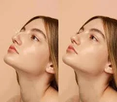 تقنية تجميلية لصيف مثالي: تصغير الأنف بدون جراحة بنتائج فورية وطبيعية تقنية تجميلية لصيف مثالي: تصغير الأنف بدون جراحة بنتائج فورية وطبيعية