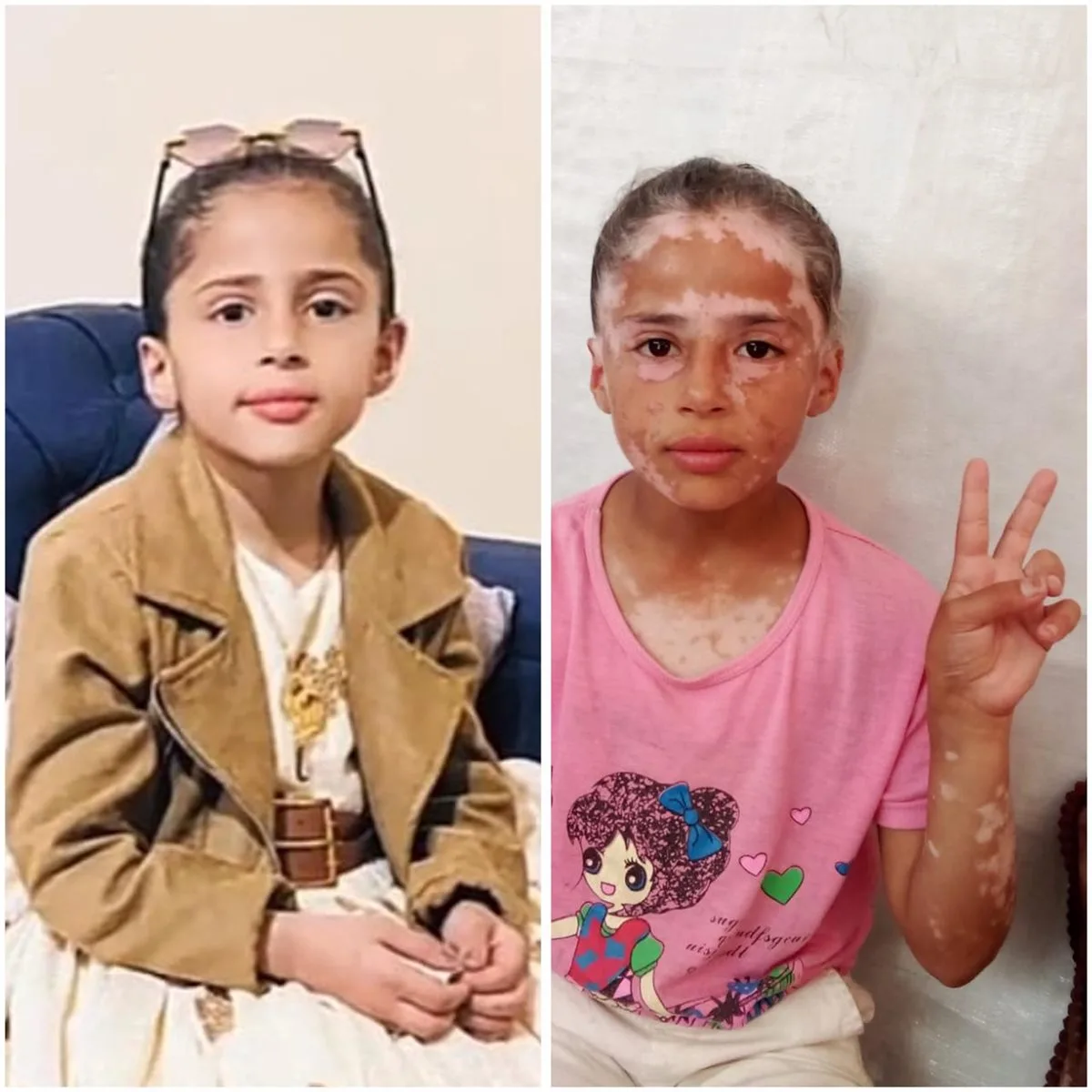 كنت جميلة قبل الحرب: لانا الشريف، طفلة فلسطينية تأثرت بالاحتلال وظهور البهاق نتيجة للخوف كنت جميلة قبل الحرب: لانا الشريف، طفلة فلسطينية تأثرت بالاحتلال وظهور البهاق نتيجة للخوف