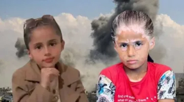 لانا، طفلة فلسطينية تأثرت بالإبادة الإسرائيلية: بدأ ظهور البقع البيضاء على جسدي بسبب الخوف من القصف المتواصل.