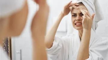 أبرزها الجبن والشوكولاتة.. أطعمة مسببة لحب الشباب تعرف عليها