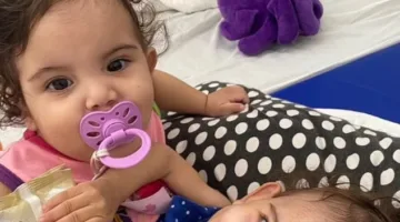 إجراء جراحي لمدة 15 ساعة لفصل توأمين ملتصقين من منطقة الصدر والبطن