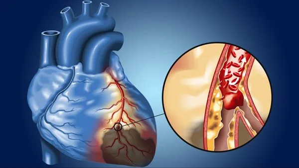 اكتشاف آلية غير متوقعة وراء تلف القلب بعد النوبات اكتشاف آلية غير متوقعة وراء تلف القلب بعد النوبات
