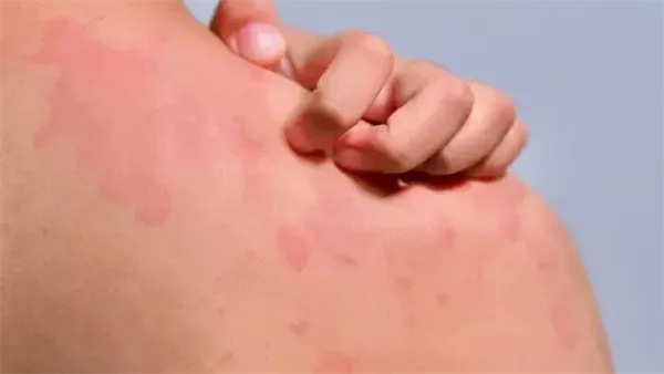 الطفح الجلدي قد يكون جرس إنذار لأمراض خفية الطفح الجلدي قد يكون جرس إنذار لأمراض خفية