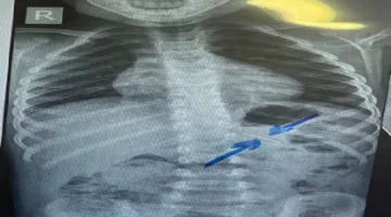 باستخدام منظار الأطفال دون مضاعفات.. فريق طبي بمستشفى سوهاج الجامعي ينجح في استخراج دبوس من معدة طفل