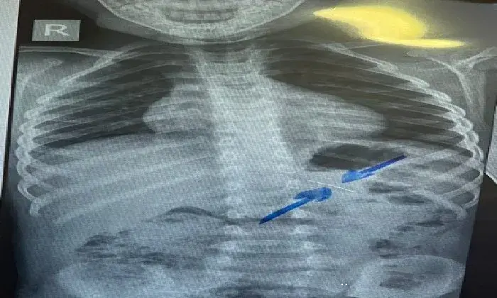 باستخدام منظار الأطفال دون مضاعفات.. فريق طبي بمستشفى سوهاج الجامعي ينجح في استخراج دبوس من معدة طفل باستخدام منظار الأطفال دون مضاعفات.. فريق طبي بمستشفى سوهاج الجامعي ينجح في استخراج دبوس من معدة طفل