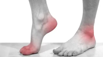 علاج النقرس بالأعشاب الطبيعية.. حلول فعالة لتخفيف الألم