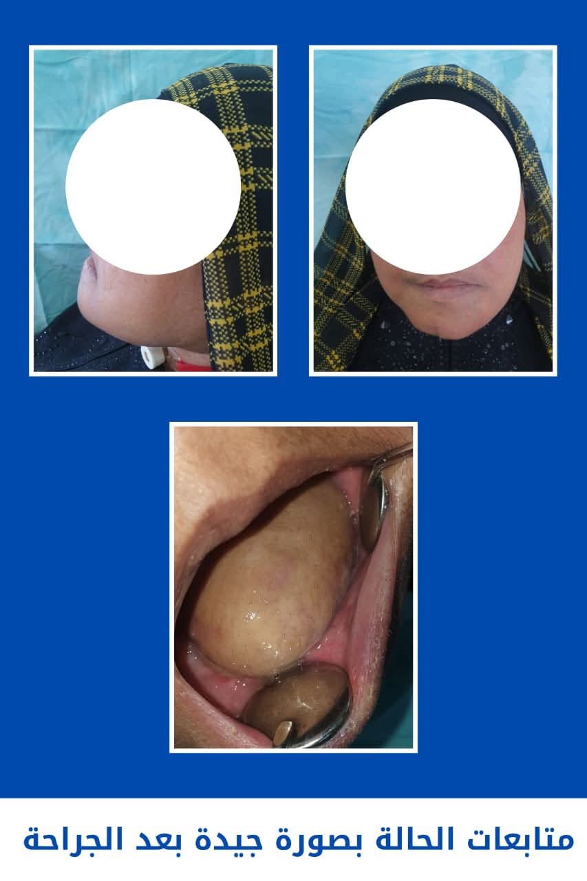 فريق طبي بجامعة طنطا ينجح استئصال ورم خبيث بالفك السفلي فريق طبي بجامعة طنطا ينجح استئصال ورم خبيث بالفك السفلي
