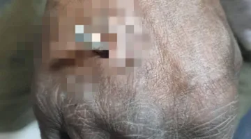 فريق طبي ينجح في استخراج «سيخ معدني» اخترق يد حدّاد بكفر الشيخ | صور