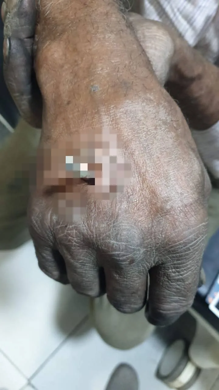 فريق طبي ينجح في استخراج «سيخ معدني» اخترق يد حدّاد بكفر الشيخ | صور فريق طبي ينجح في استخراج «سيخ معدني» اخترق يد حدّاد بكفر الشيخ | صور