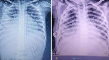 نجاح إجراء “إزالة الغشاء البلوري” لطفل في مستشفى برج العرب