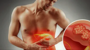 يسبب التليف.. أعراض الكبد الدهني وأهم أسبابه