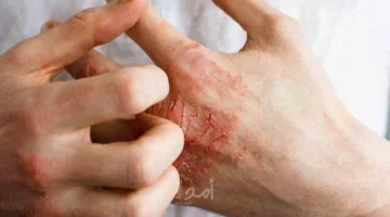 أبرز مشاكل البشرة في الصيف