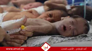 تقارير طبية: زيادة عدد الأطفال الذين فقدوا حياتهم بسبب سوء التغذية إلى 66 طفلًا