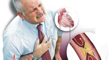 أسباب نزيف الأنف والأشخاص الأكثر تعرضًا له، بما في ذلك أدوية معروفة.