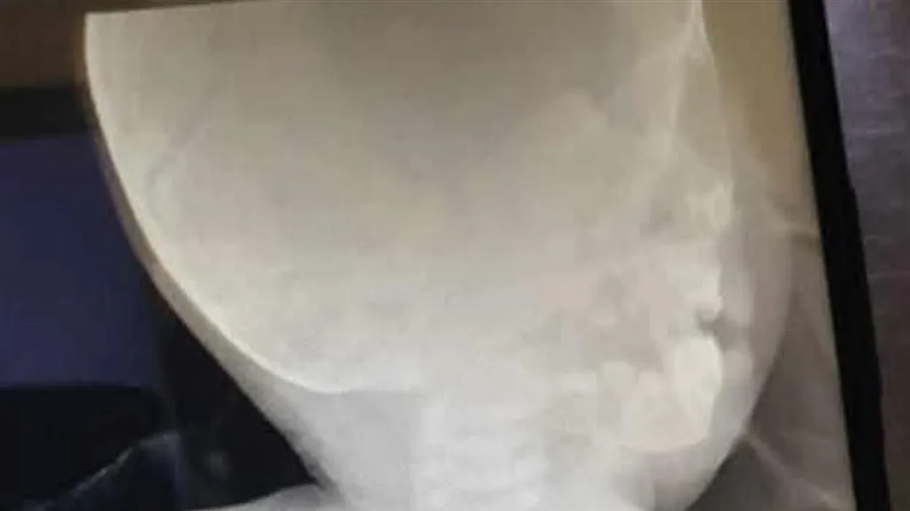 نينوى.. إنقاذ طفل بعد ابتلاعه حبة زيتون نينوى.. إنقاذ طفل بعد ابتلاعه حبة زيتون