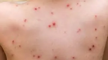 منظمة الصحة العالمية تكشف عن المخاطر المرتبطة بمرض جدري القرود