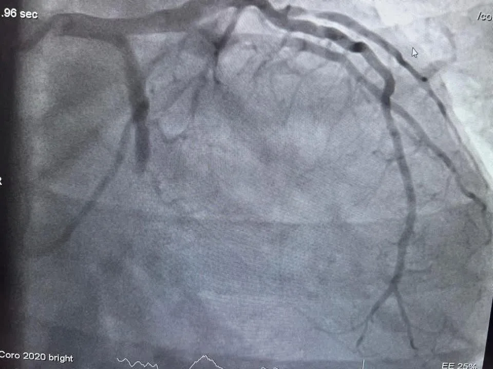 إعادة الحياة لمريض تعرض لجلطة وشلل في مستشفى المنصورة التخصصي إعادة الحياة لمريض تعرض لجلطة وشلل في مستشفى المنصورة التخصصي