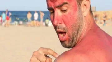 قبل أن يتحول مصيفك إلى كابوس.. اكتشف طرق معالجة حروق الشمس