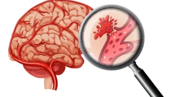 جهاز طبي حديث.. ابتكار جديد لعلاج السكتات الدماغية | معلومات إضافية