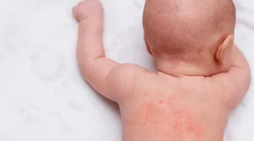 حمو النيل لدى الأطفال: طرق لحماية طفلك من حرارة الصيف